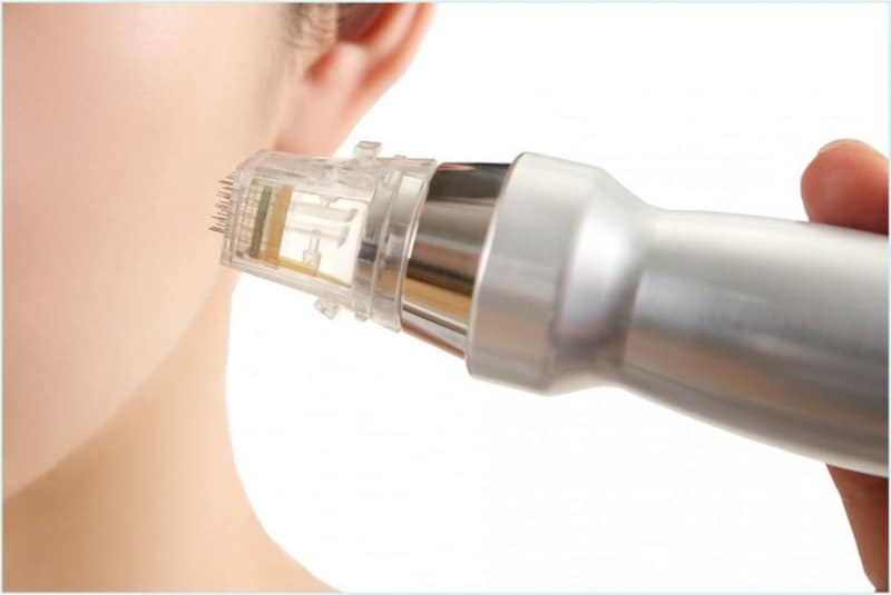 Radiofrequenz (RF) Microneedling